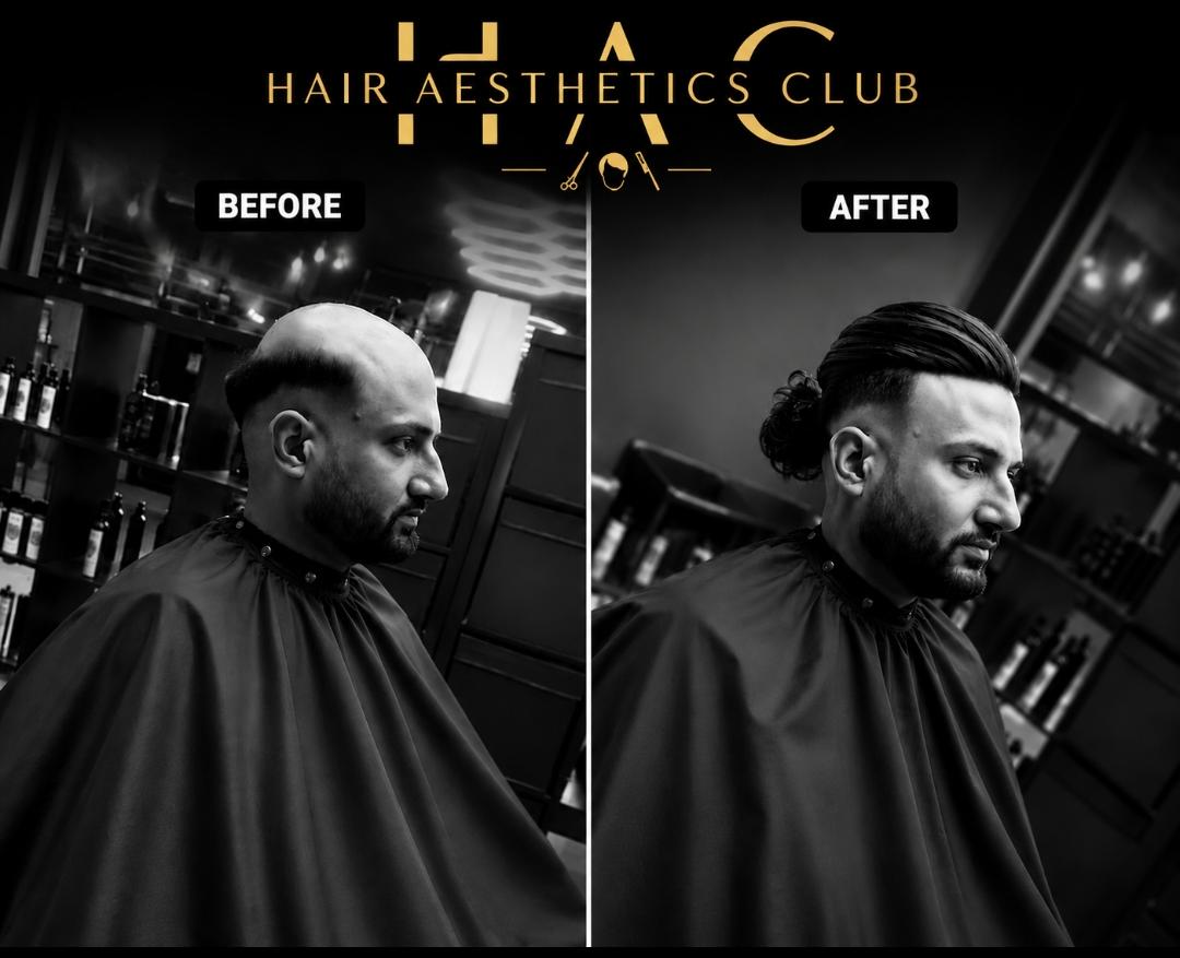 Before and after: Hair Aesthetics Club client — hair system fitting, single session