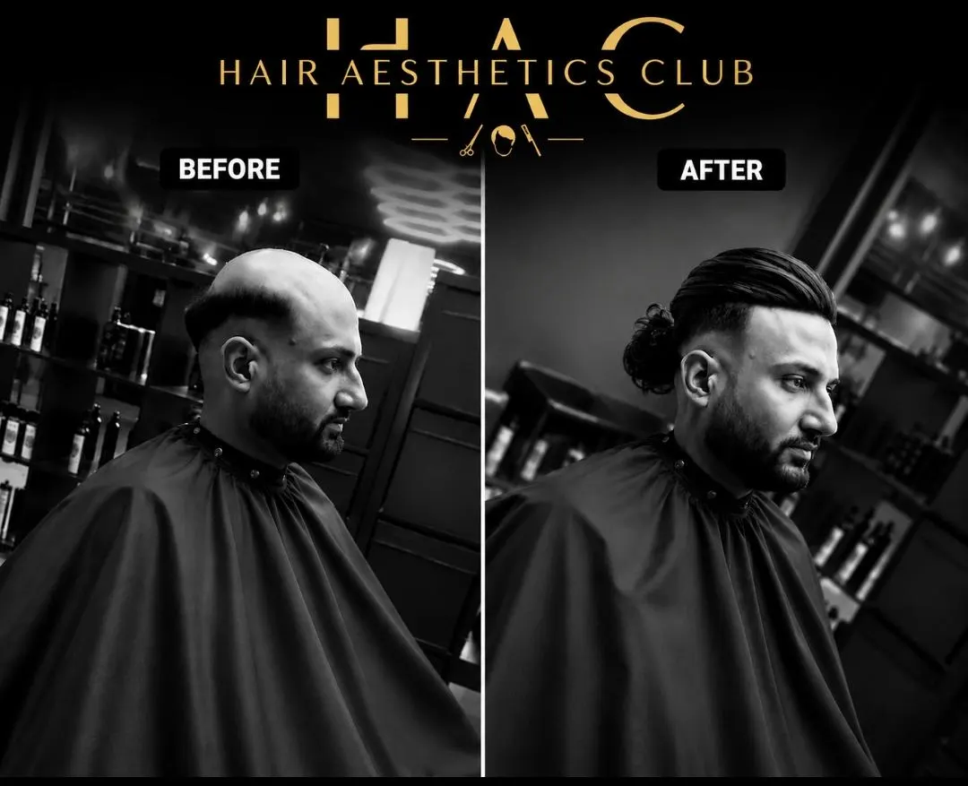 Before and after: Hair Aesthetics Club client — from hair loss to full natural-looking hair in one session